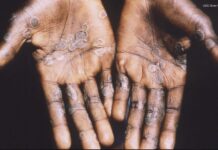 Monkeypox likely spread by sex at 2 raves in Europe