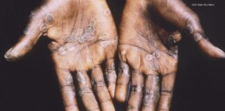 Monkeypox likely spread by sex at 2 raves in Europe