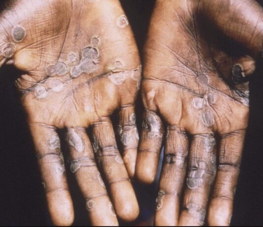 Monkeypox likely spread by sex at 2 raves in Europe