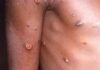 NCDC dismisses Russia’s working with US, monkeypox