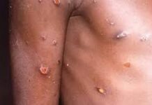 NCDC dismisses Russia’s working with US, monkeypox