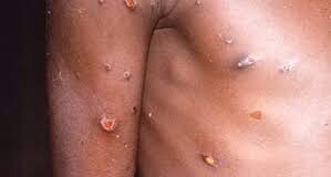NCDC dismisses Russia’s working with US, monkeypox