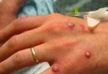 Monkeypox raises to triple in Europe: WHO