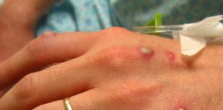 Monkeypox raises to triple in Europe: WHO