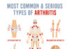 Common types of arthritis