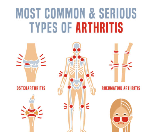 Common types of arthritis