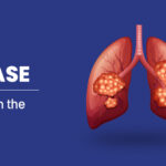 Lung Disease Overview
